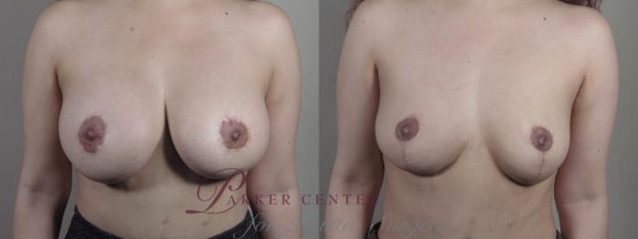 Breast Implant Removal Case 1370 Before & After Front | Paramus, NJ | Parker Center for Plastic Surgery