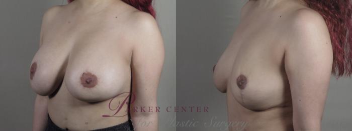 Breast Implant Removal Case 1370 Before & After Left Oblique | Paramus, NJ | Parker Center for Plastic Surgery