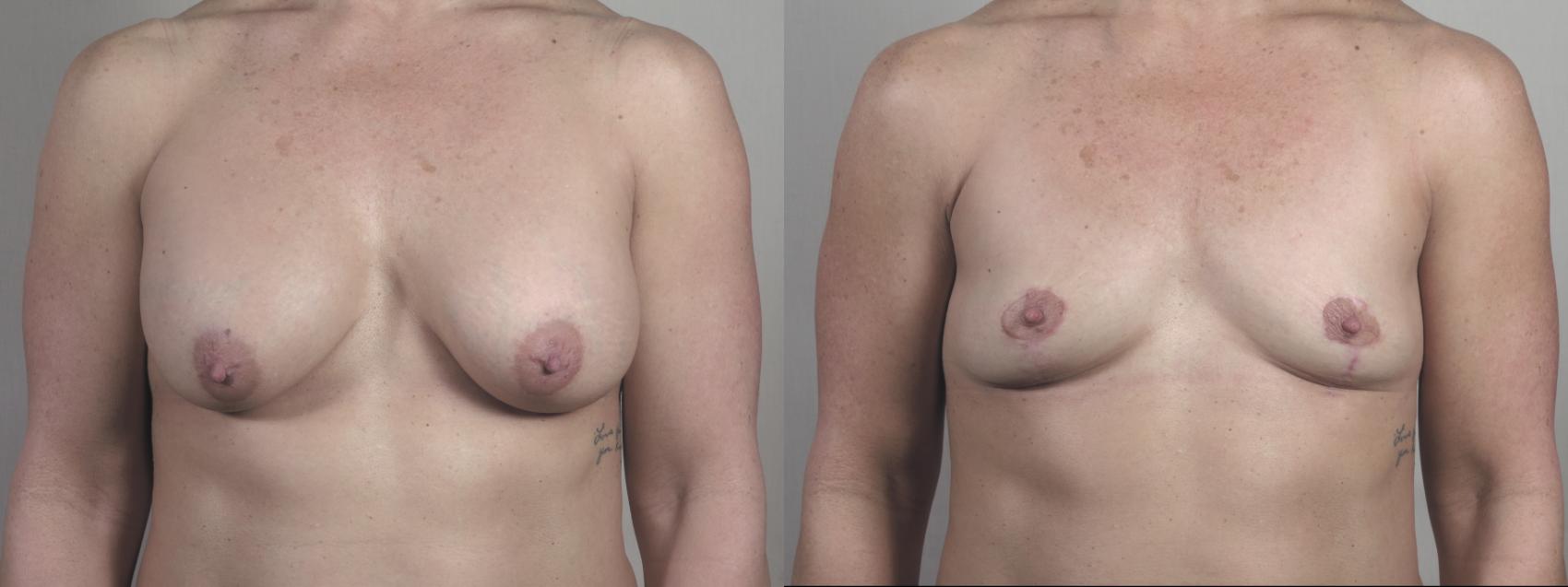 Breast Implant Removal Case 1398 Before & After Front | Paramus, New Jersey | Parker Center for Plastic Surgery