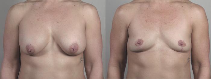 Breast Implant Removal Case 1398 Before & After Front | Paramus, New Jersey | Parker Center for Plastic Surgery