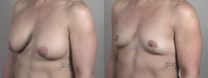 Breast Implant Removal Case 1398 Before & After Left Side | Paramus, New Jersey | Parker Center for Plastic Surgery