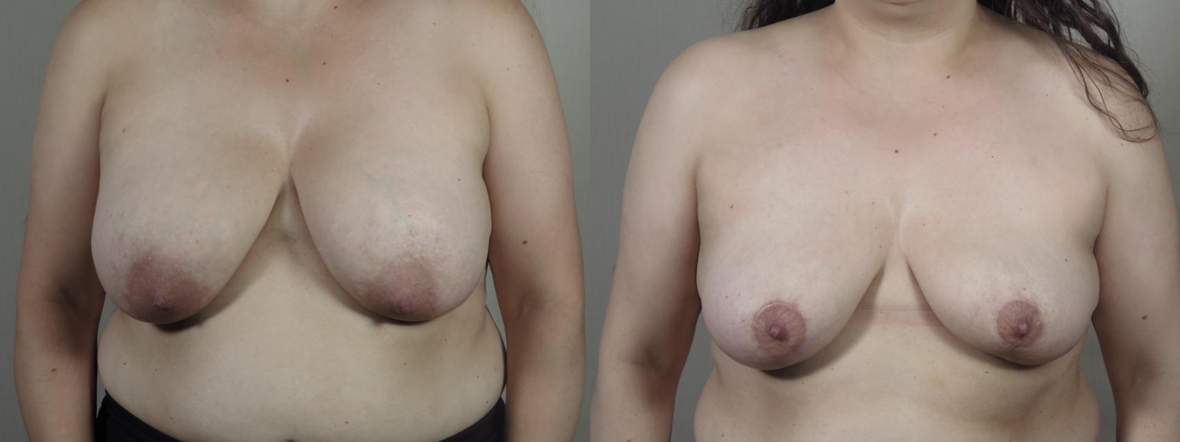 Breast Implant Removal Case 1401 Before & After Front | Paramus, New Jersey | Parker Center for Plastic Surgery