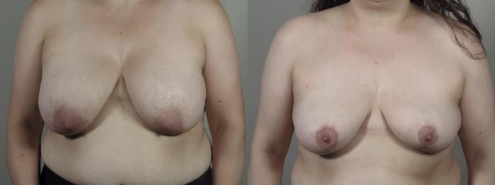 Breast Implant Removal Case 1401 Before & After Front | Paramus, New Jersey | Parker Center for Plastic Surgery