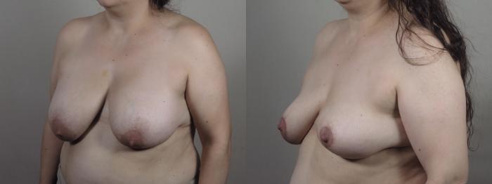 Breast Implant Removal Case 1401 Before & After side view | Paramus, New Jersey | Parker Center for Plastic Surgery