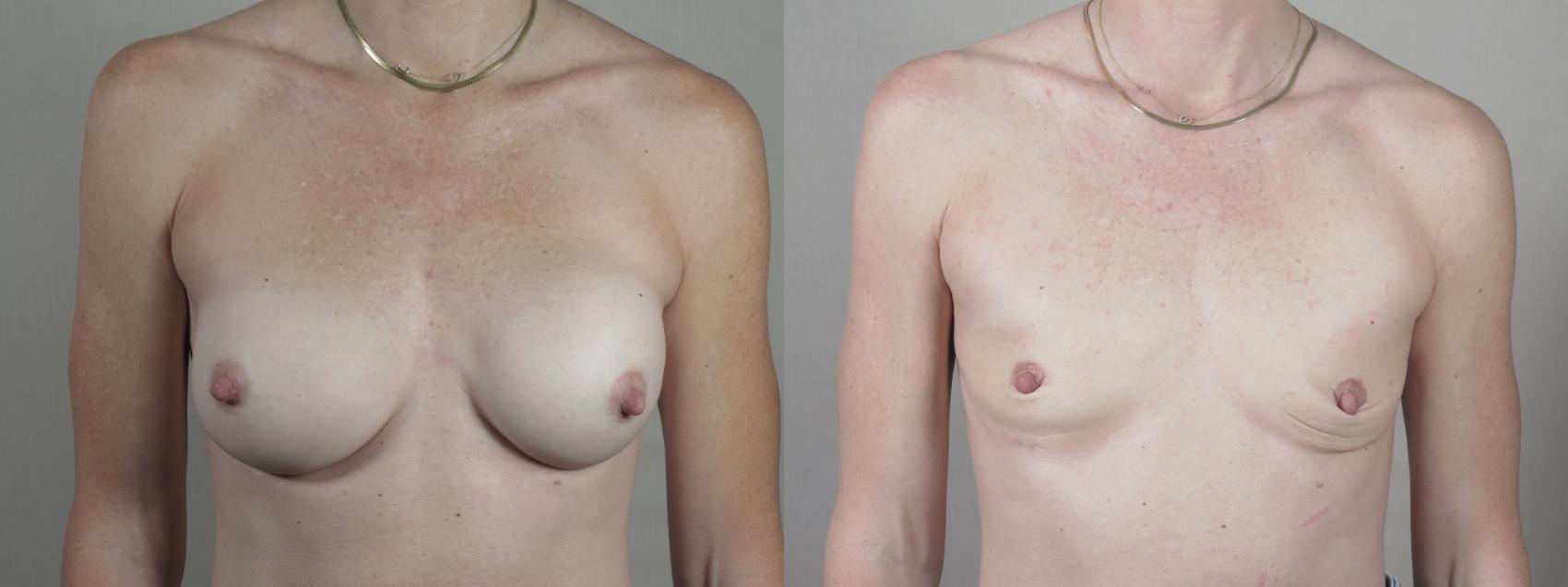 Breast Implant Removal Case 1403 Before & After Front | Paramus, New Jersey | Parker Center for Plastic Surgery