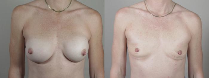 Breast Implant Removal Case 1403 Before & After Front | Paramus, New Jersey | Parker Center for Plastic Surgery