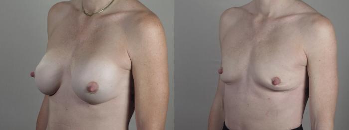 Breast Implant Removal Case 1403 Before & After Side view | Paramus, New Jersey | Parker Center for Plastic Surgery