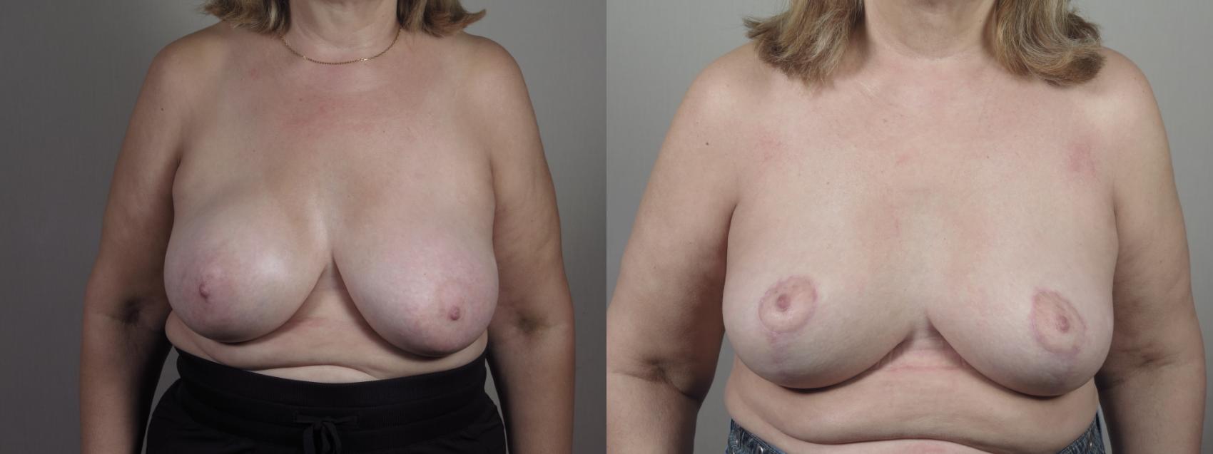 Breast Implant Removal Case 1408 Before & After Front | Paramus, New Jersey | Parker Center for Plastic Surgery