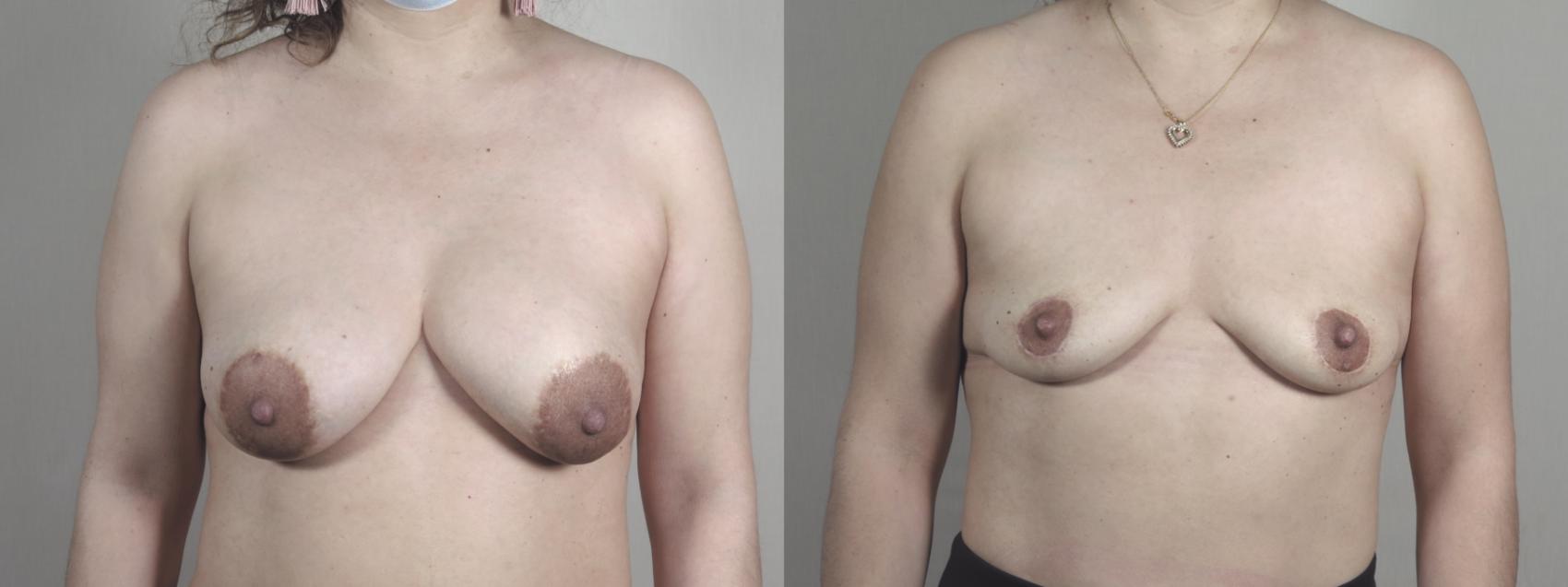 Breast Implant Removal Case 1456 Before & After Front | Paramus, New Jersey | Parker Center for Plastic Surgery