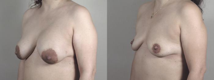 Breast Implant Removal Case 1456 Before & After Left Oblique | Paramus, New Jersey | Parker Center for Plastic Surgery