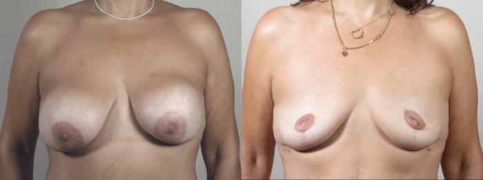 Breast Implant Removal Case 1490 Before & After Front | Paramus, New Jersey | Parker Center for Plastic Surgery