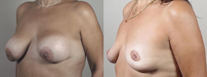 Breast Implant Removal Case 1490 Before & After Left Oblique | Paramus, New Jersey | Parker Center for Plastic Surgery