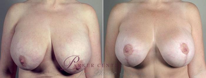 Breast Implant Removal Case 553 Before & After View #1 | Paramus, NJ | Parker Center for Plastic Surgery