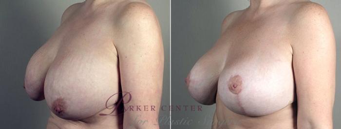Breast Implant Removal Case 553 Before & After View #2 | Paramus, NJ | Parker Center for Plastic Surgery