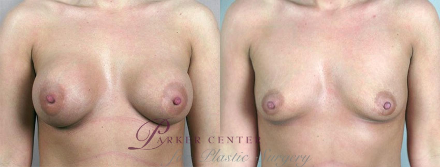 Breast Implant Removal Case 573 Before & After View #1 | Paramus, NJ | Parker Center for Plastic Surgery