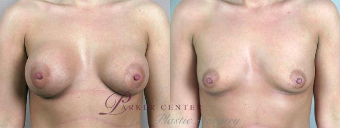Breast Implant Removal Case 573 Before & After View #1 | Paramus, NJ | Parker Center for Plastic Surgery