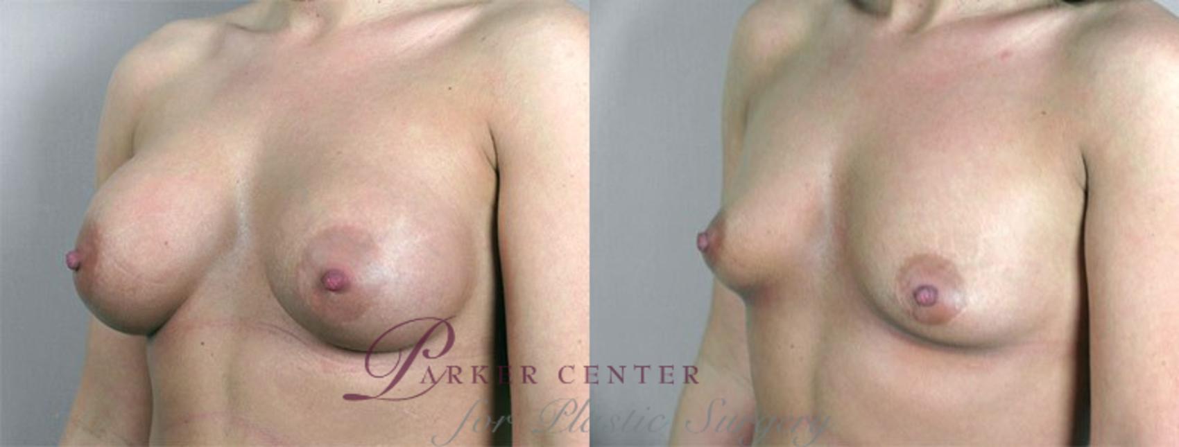 Breast Implant Removal Case 573 Before & After View #2 | Paramus, NJ | Parker Center for Plastic Surgery