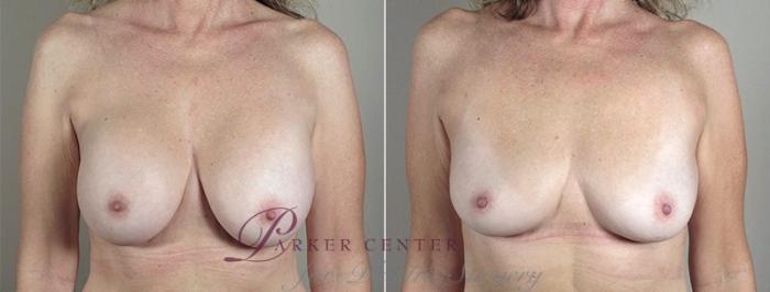 Breast Implant Removal Case 574 Before & After View #1 | Paramus, NJ | Parker Center for Plastic Surgery