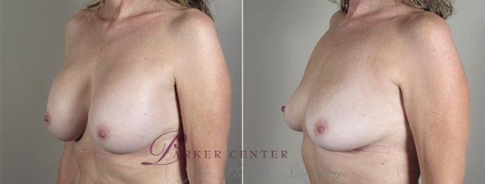 Breast Implant Removal Case 574 Before & After View #2 | Paramus, NJ | Parker Center for Plastic Surgery