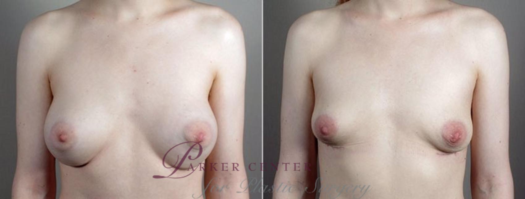 Breast Implant Removal Case 575 Before & After View #1 | Paramus, NJ | Parker Center for Plastic Surgery