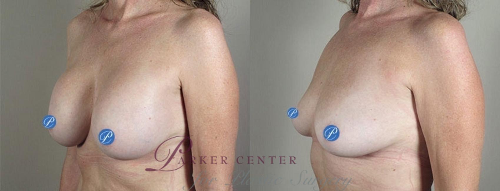 Breast Implant Removal Case 907 Before & After View #5 | Paramus, NJ | Parker Center for Plastic Surgery