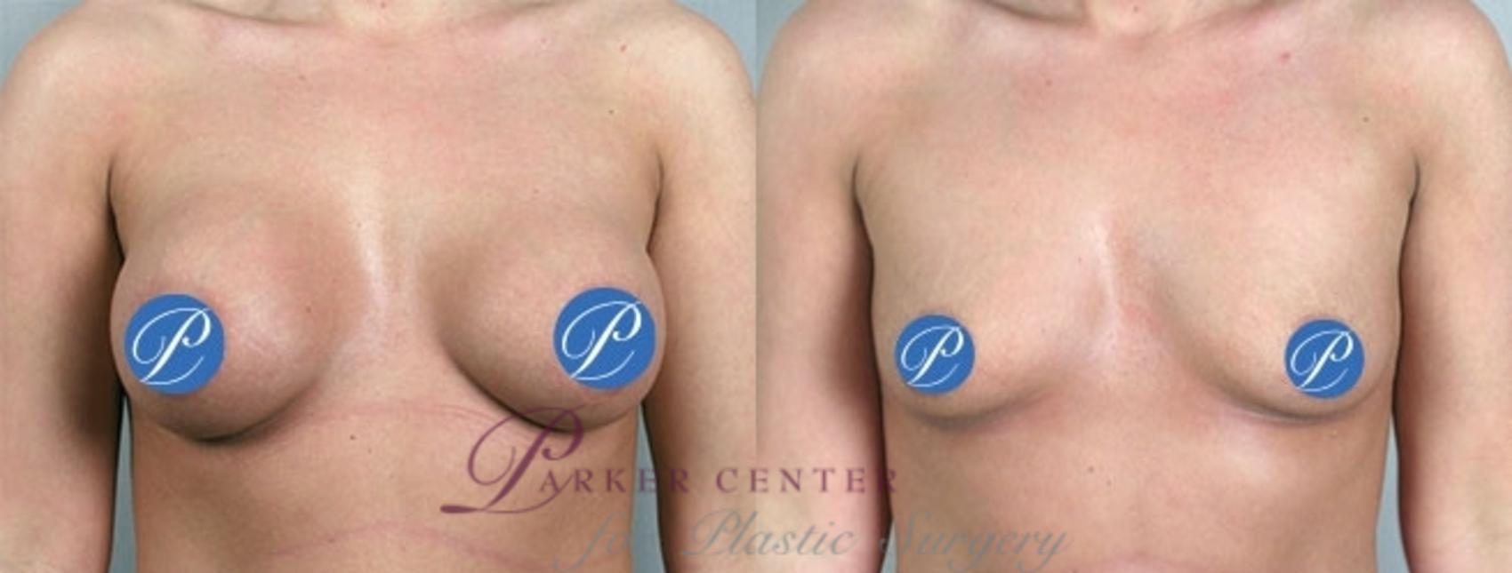 Breast Implant Removal Case 908 Before & After View #5 | Paramus, NJ | Parker Center for Plastic Surgery