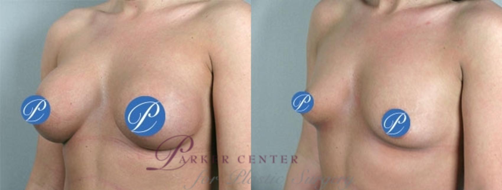 Breast Implant Removal Case 908 Before & After View #side1 | Paramus, NJ | Parker Center for Plastic Surgery