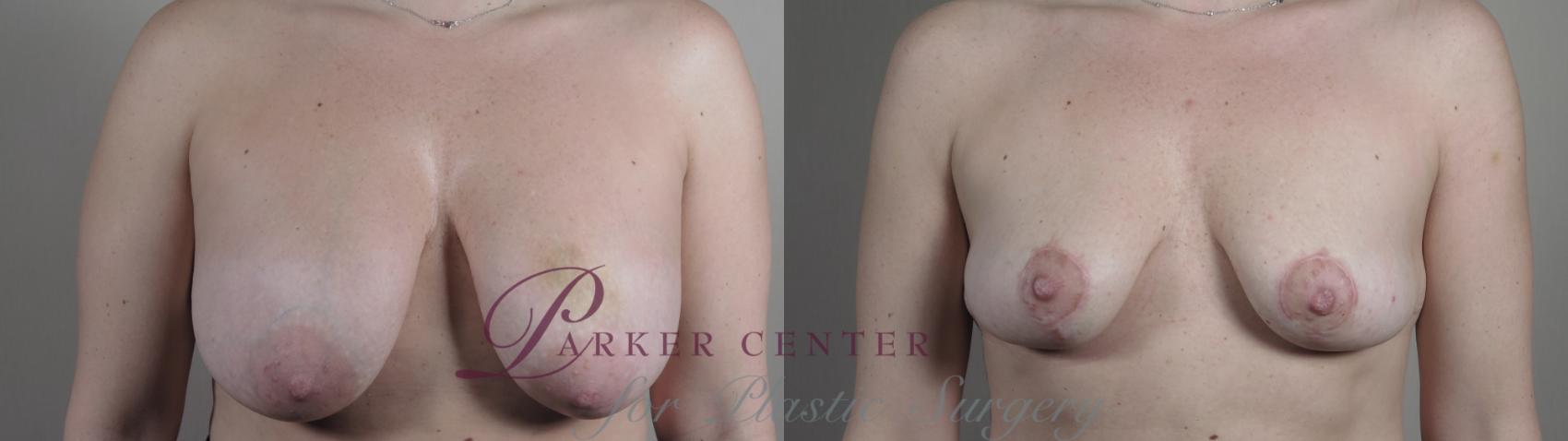 Breast Implant Removal Case 983 Before & After Front | Paramus, NJ | Parker Center for Plastic Surgery