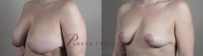 Breast Implant Removal Case 983 Before & After Right Oblique | Paramus, NJ | Parker Center for Plastic Surgery