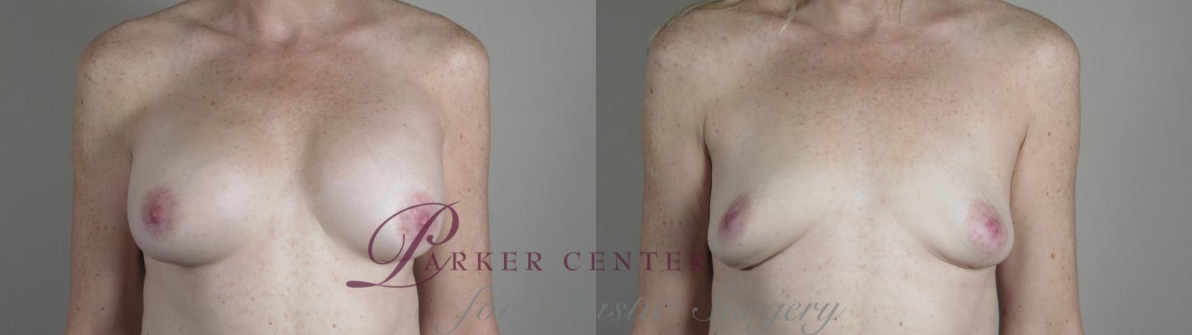 Breast Implant Removal Case 991 Before & After Front | Paramus, NJ | Parker Center for Plastic Surgery