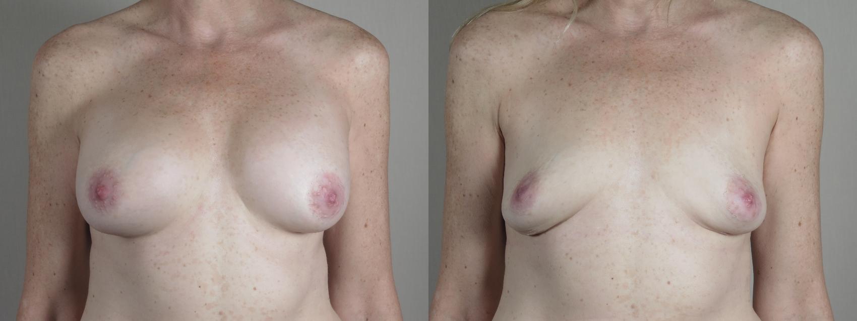 Breast Implant Removal Case 991 Before & After Front | Paramus, New Jersey | Parker Center for Plastic Surgery