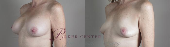 Breast Implant Removal Case 991 Before & After Right Oblique | Paramus, NJ | Parker Center for Plastic Surgery