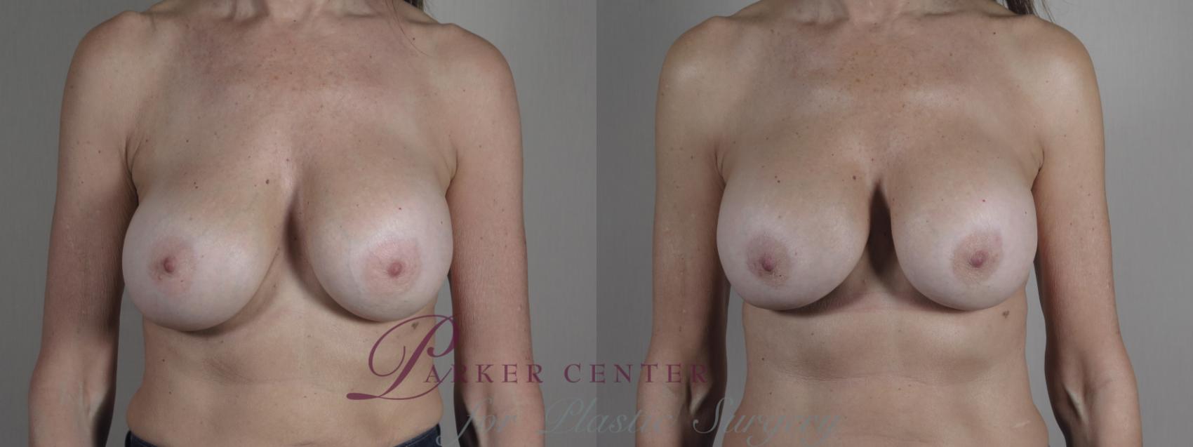 Breast Implant Revision Case 1025 Before & After Front | Paramus, NJ | Parker Center for Plastic Surgery