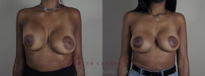 Breast Implant Revision Case 1199 Before & After View #1  | Paramus, NJ | Parker Center for Plastic Surgery
