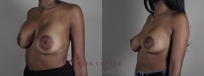 Breast Implant Revision Case 1199 Before & After View #2 | Paramus, NJ | Parker Center for Plastic Surgery
