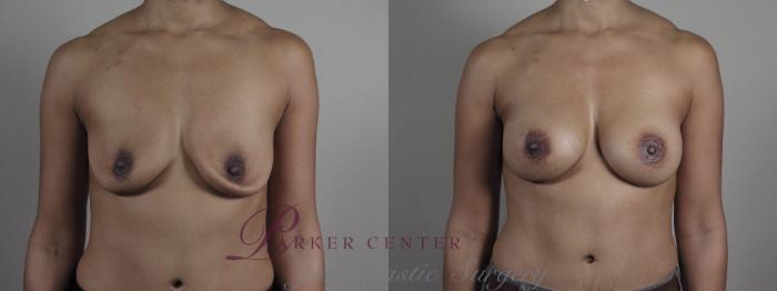 Breast Implant Revision Case 1204 Before & After View #1  | Paramus, NJ | Parker Center for Plastic Surgery