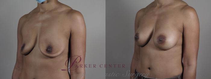 Breast Implant Revision Case 1204 Before & After View #2 | Paramus, NJ | Parker Center for Plastic Surgery