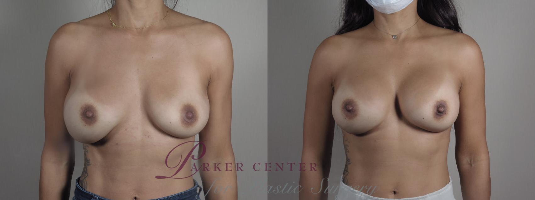 Breast Implant Revision Case 1220 Before & After View #1  | Paramus, NJ | Parker Center for Plastic Surgery