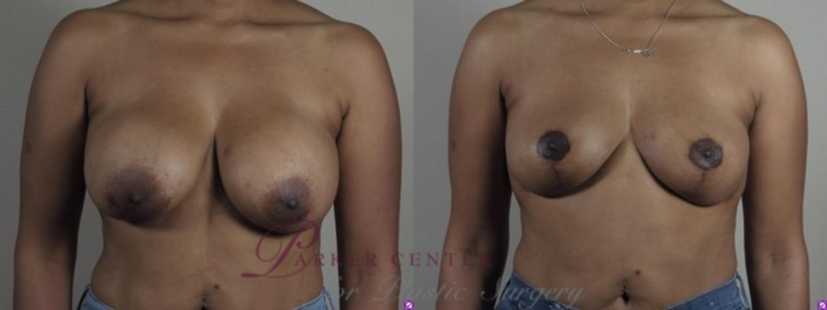 Breast Implant Revision Case 1249 Before & After Front | Paramus, NJ | Parker Center for Plastic Surgery