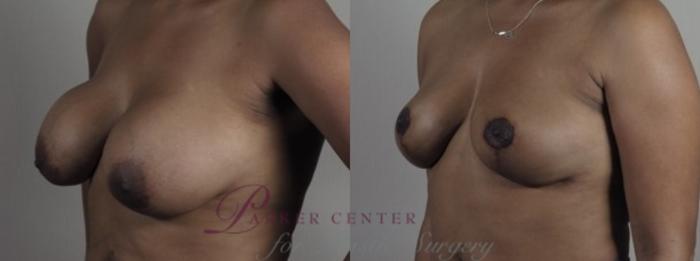 Breast Implant Revision Case 1249 Before & After Left Oblique | Paramus, NJ | Parker Center for Plastic Surgery
