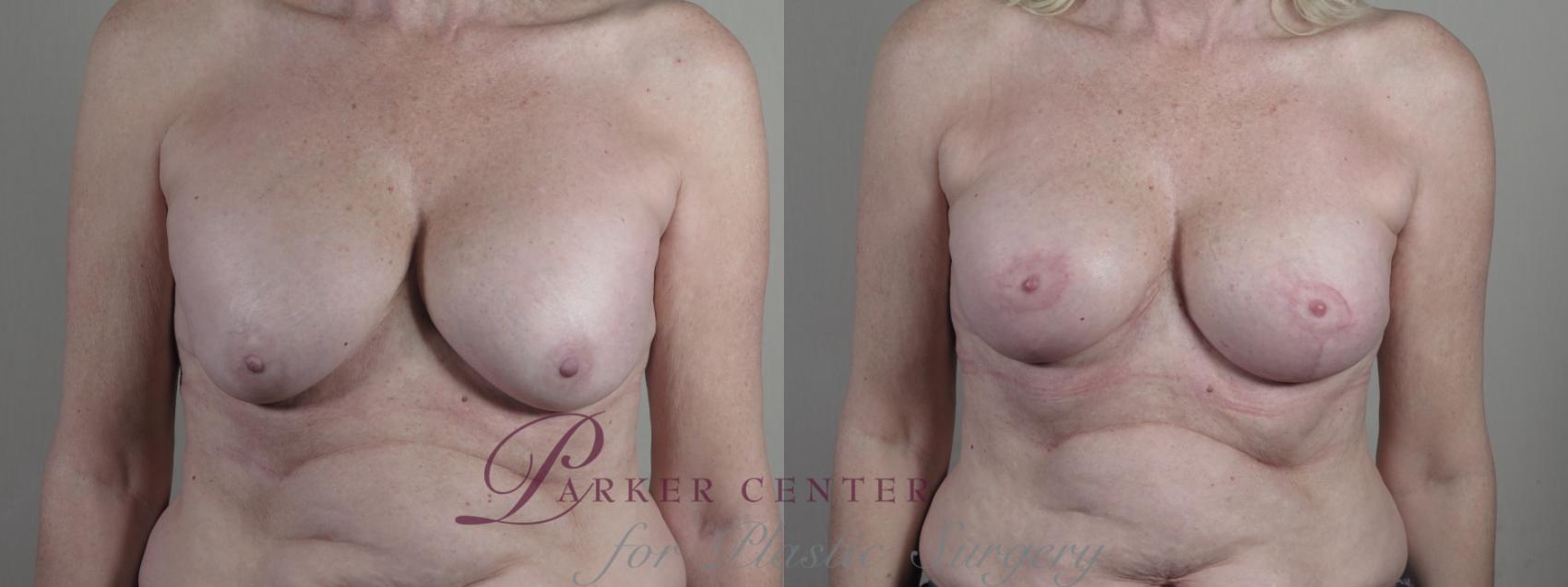 Breast Implant Revision Case 1324 Before & After Front | Paramus, NJ | Parker Center for Plastic Surgery
