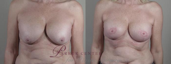 Breast Implant Revision Case 1324 Before & After Front | Paramus, NJ | Parker Center for Plastic Surgery