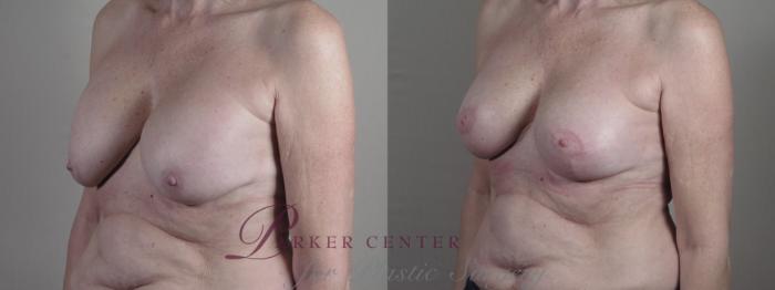 Breast Implant Revision Case 1324 Before & After Left Oblique | Paramus, NJ | Parker Center for Plastic Surgery