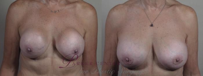 Breast Implant Revision Case 1377 Before & After Front | Paramus, NJ | Parker Center for Plastic Surgery