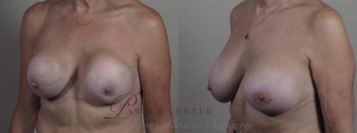 Breast Implant Revision Case 1377 Before & After Left Oblique | Paramus, NJ | Parker Center for Plastic Surgery