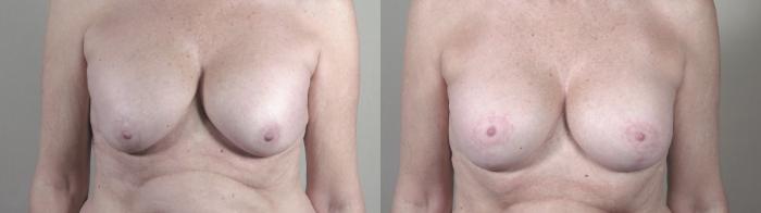 Breast Implant Revision Case 1390 Before & After Front | Paramus, New Jersey | Parker Center for Plastic Surgery