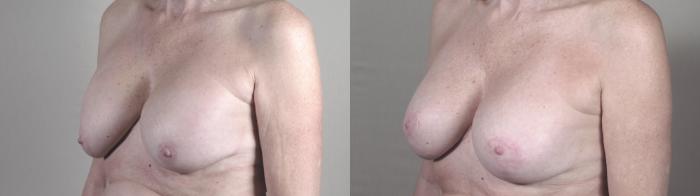 Breast Implant Revision Case 1390 Before & After Side view | Paramus, New Jersey | Parker Center for Plastic Surgery