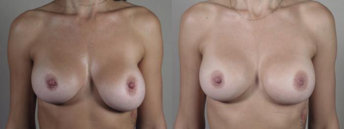 Breast Implant Revision Case 1394 Before & After Front | Paramus, New Jersey | Parker Center for Plastic Surgery