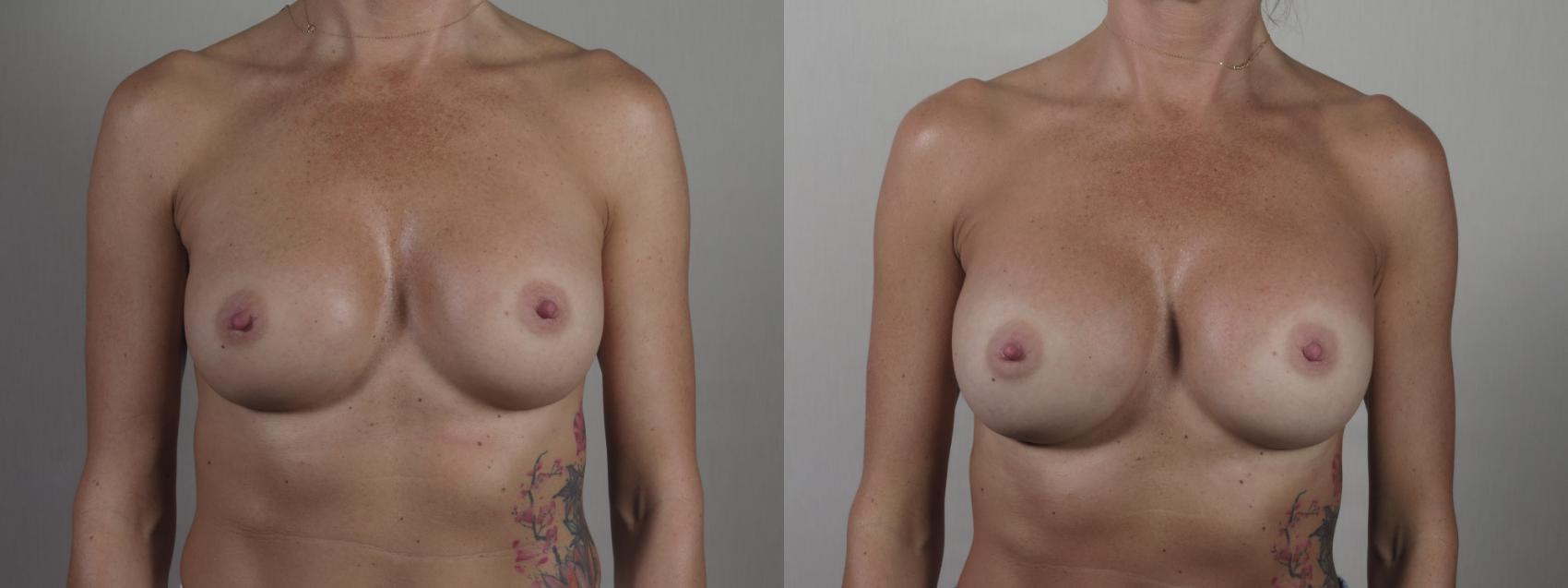 Breast Implant Revision Case 1406 Before & After Front | Paramus, New Jersey | Parker Center for Plastic Surgery