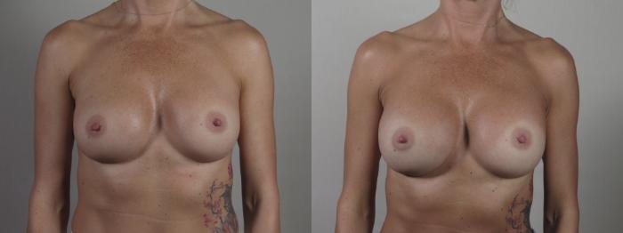 Breast Implant Revision Case 1406 Before & After Front | Paramus, New Jersey | Parker Center for Plastic Surgery